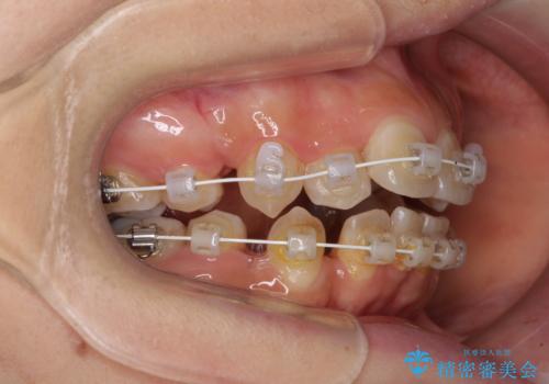見えないほど重なっている前歯 抜歯矯正でスッキリとした歯並びにの治療中
