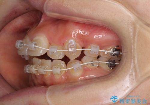 見えないほど重なっている前歯　抜歯矯正でスッキリとした歯並びにの治療中