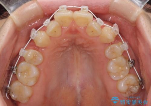 見えないほど重なっている前歯 抜歯矯正でスッキリとした歯並びにの治療中
