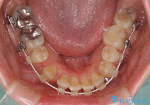 見えないほど重なっている前歯　抜歯矯正でスッキリとした歯並びにの治療中