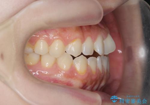 [ インビザライン ]前歯のねじれ、噛み合わせを治したいの治療前