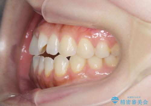 [ インビザライン ]前歯のねじれ、噛み合わせを治したいの治療前