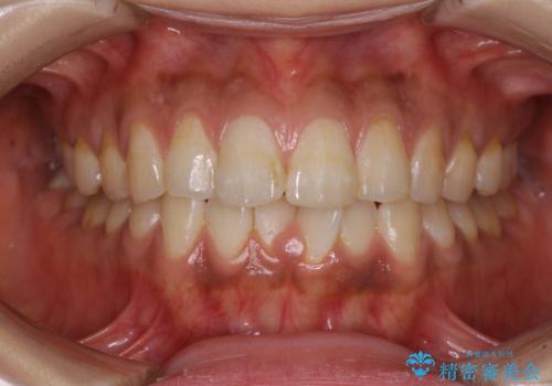 上下前歯の前歯と腫れやすい歯肉　インビザライン矯正で改善の症例 治療前