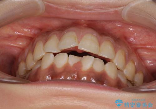 上下前歯の前歯と腫れやすい歯肉 インビザライン矯正で改善の治療前