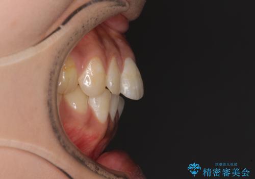 上下前歯の前歯と腫れやすい歯肉 インビザライン矯正で改善の治療前