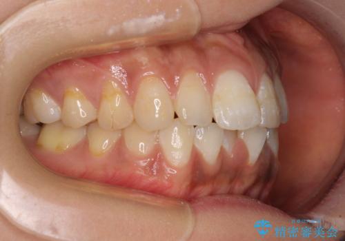 上下前歯の前歯と腫れやすい歯肉 インビザライン矯正で改善の治療前