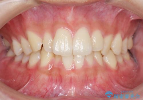 [ 下顎3前歯の矯正治療 ]  3インサイザー仕上げのマウスピース矯正の症例 治療前