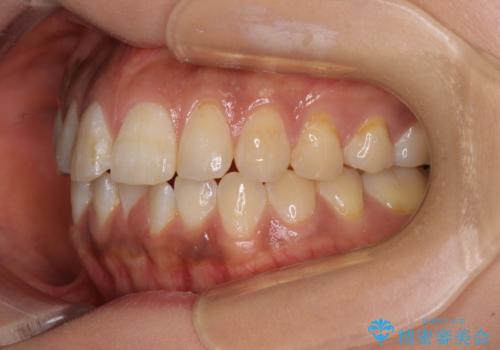 上下前歯の前歯と腫れやすい歯肉　インビザライン矯正で改善の治療前