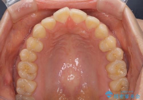 上下前歯の前歯と腫れやすい歯肉　インビザライン矯正で改善の治療前