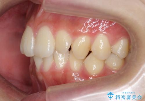 [ 下顎3前歯の矯正治療 ]  3インサイザー仕上げのマウスピース矯正の治療前