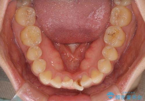 上下前歯の前歯と腫れやすい歯肉 インビザライン矯正で改善の治療前