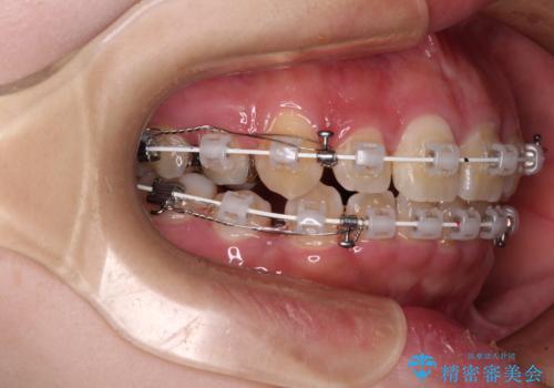 閉じにくい口元と八重歯　ワイヤー装置での抜歯矯正の治療中
