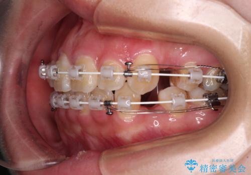閉じにくい口元と八重歯　ワイヤー装置での抜歯矯正の治療中