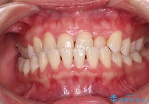 前歯の反対咬合　急速拡大装置とワイヤー装置であっという間の矯正治療の症例 治療前