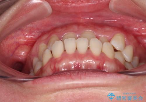 前歯の反対咬合 急速拡大装置とワイヤー装置であっという間の矯正治療の治療前