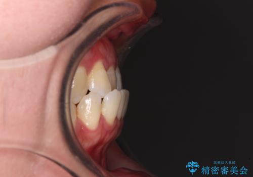 前歯の反対咬合　急速拡大装置とワイヤー装置であっという間の矯正治療の治療前
