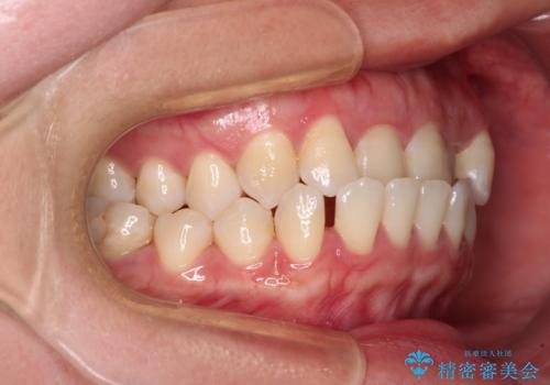 前歯の反対咬合 急速拡大装置とワイヤー装置であっという間の矯正治療の治療前