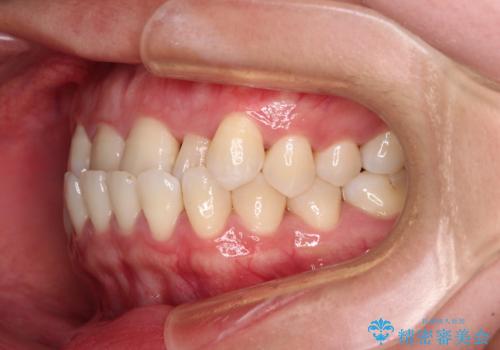 前歯の反対咬合　急速拡大装置とワイヤー装置であっという間の矯正治療の治療前