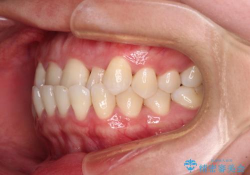 前歯の反対咬合 急速拡大装置とワイヤー装置であっという間の矯正治療の治療前