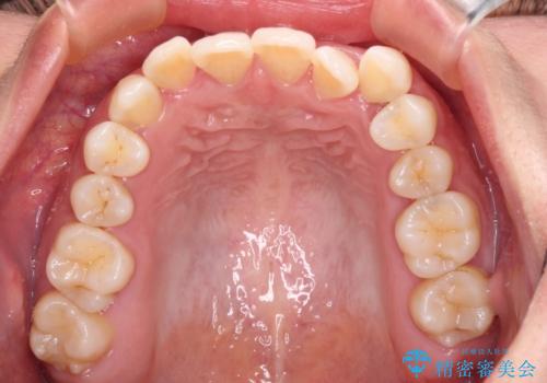 前歯の反対咬合 急速拡大装置とワイヤー装置であっという間の矯正治療の治療前
