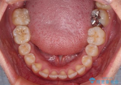 前歯の反対咬合 急速拡大装置とワイヤー装置であっという間の矯正治療の治療前