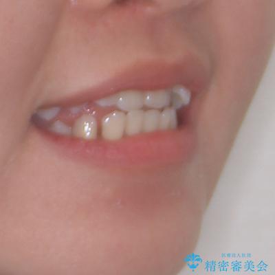 前歯の反対咬合　急速拡大装置とワイヤー装置であっという間の矯正治療の治療前（顔貌）