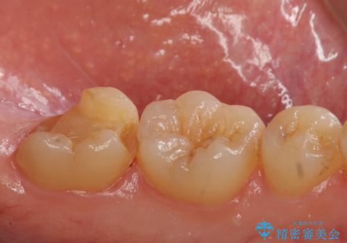 他院で入れたセラミックインレーが取れた。の治療前