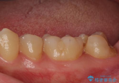 他院で入れたセラミックインレーが取れた。の治療前