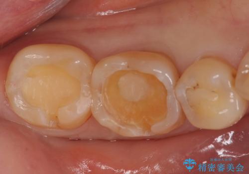 奥歯がしみる。の治療中