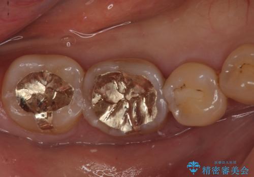 奥歯がしみる。の症例 治療後