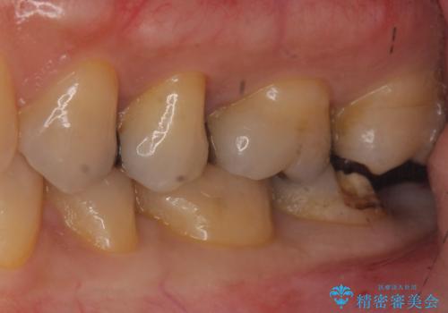 銀の詰め物が取れた。の治療前