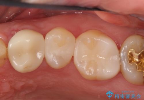 【保険治療したところが再び虫歯に】セラミックインレーで治療の治療後