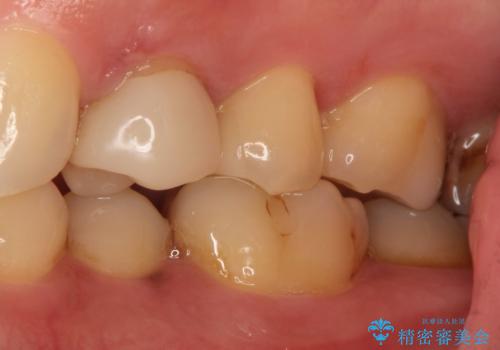 【保険治療したところが再び虫歯に】セラミックインレーで治療の治療後