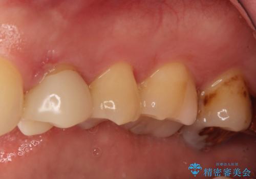 【保険治療したところが再び虫歯に】セラミックインレーで治療の治療後