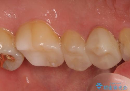 【保険治療したところが再び虫歯に】セラミックインレーで治療の治療後