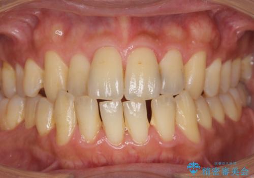 前歯のセラミック治療の治療前