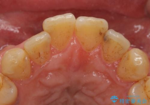 前歯のセラミック治療の治療前