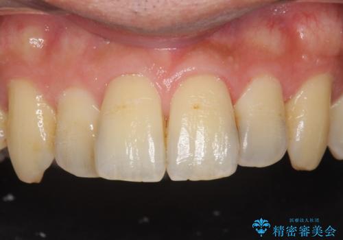 前歯のセラミック治療