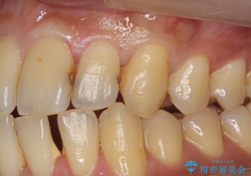 前歯のセラミック治療の治療前
