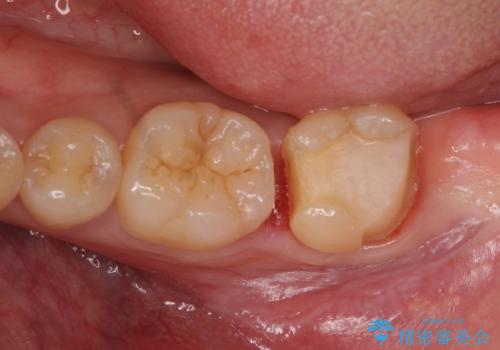 他院で入れたセラミックインレーが取れた。の治療中