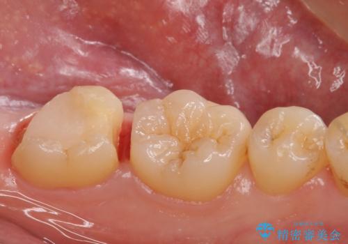 他院で入れたセラミックインレーが取れた。の治療中