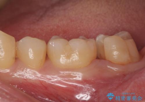 他院で入れたセラミックインレーが取れた。の治療中