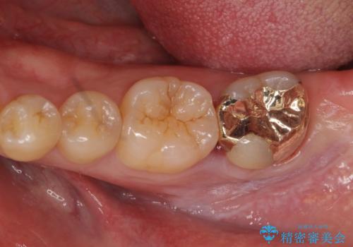 他院で入れたセラミックインレーが取れた。の症例 治療後