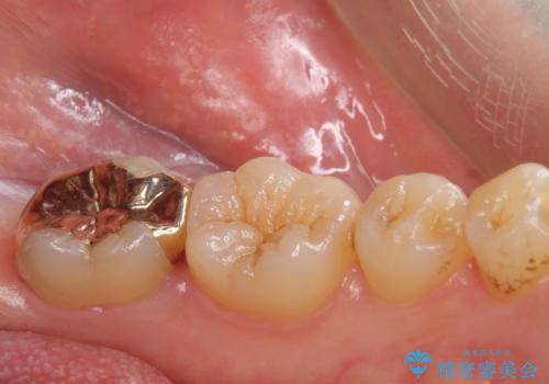 他院で入れたセラミックインレーが取れた。の治療後