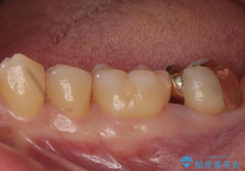 他院で入れたセラミックインレーが取れた。の治療後