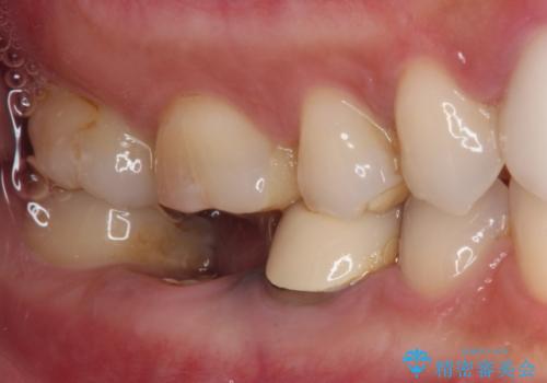 抜歯と言われた奥歯を残したい 奥歯を保存するセラミック治療の治療前