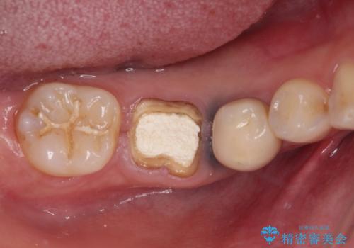 抜歯と言われた奥歯を残したい　奥歯を保存するセラミック治療の症例 治療前