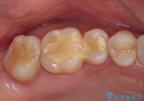 抜歯と言われた奥歯を残したい 奥歯を保存するセラミック治療の治療前