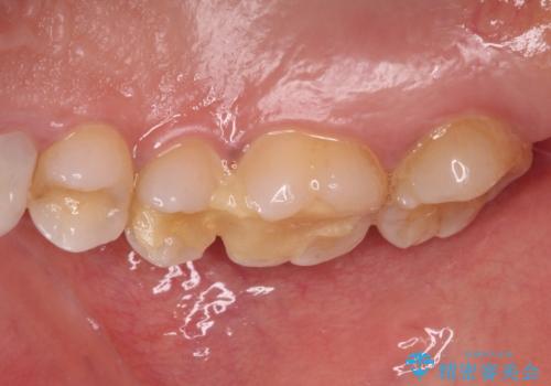 抜歯と言われた奥歯を残したい 奥歯を保存するセラミック治療の治療前