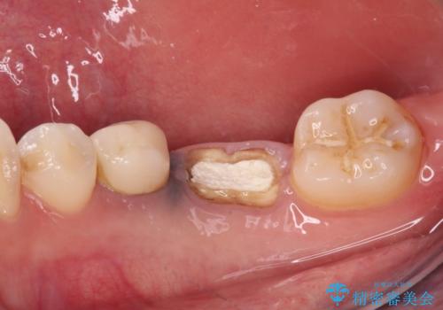 抜歯と言われた奥歯を残したい 奥歯を保存するセラミック治療の治療前